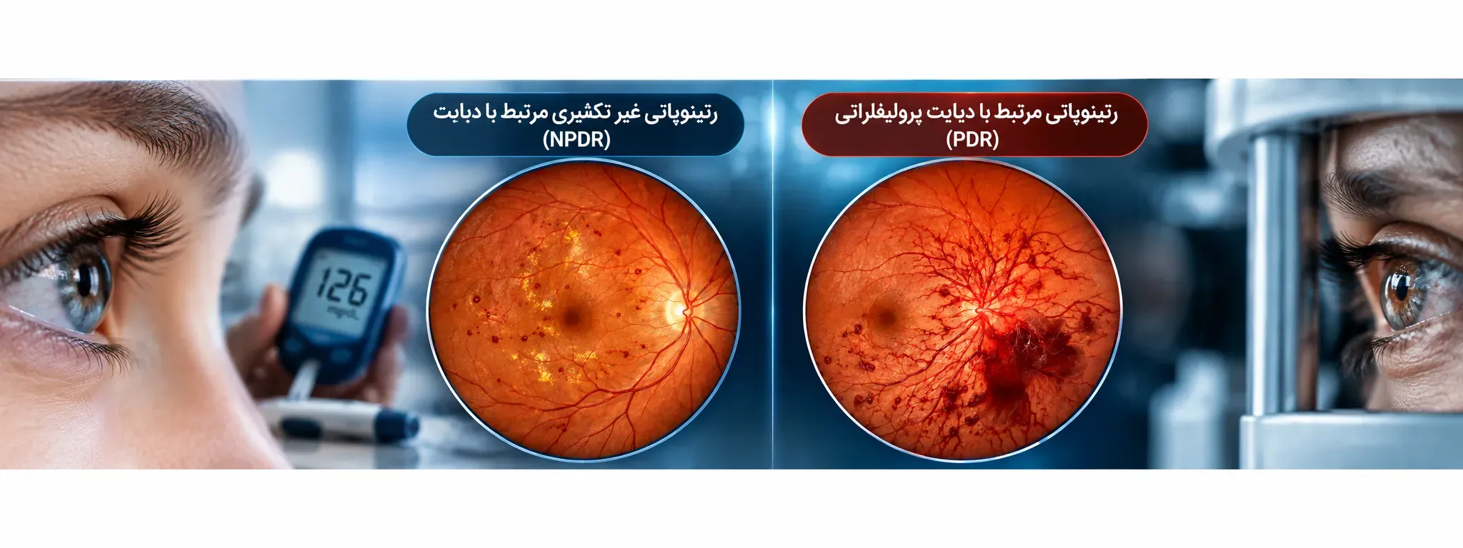 بیماری چشم